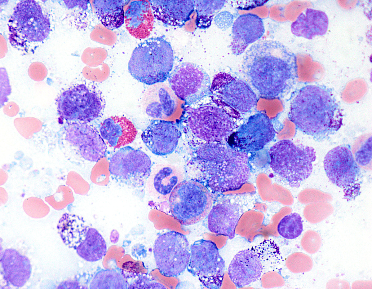 Primitive mast cells on the bone marrow aspirate were morphologically variable (Wright-Giemsa).